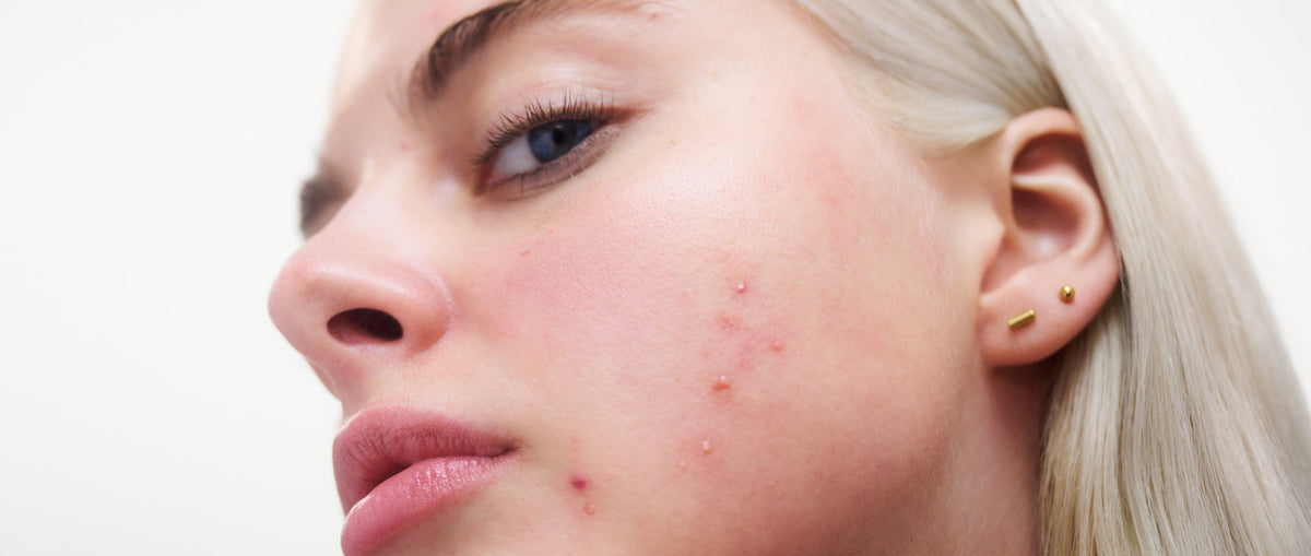 Acne