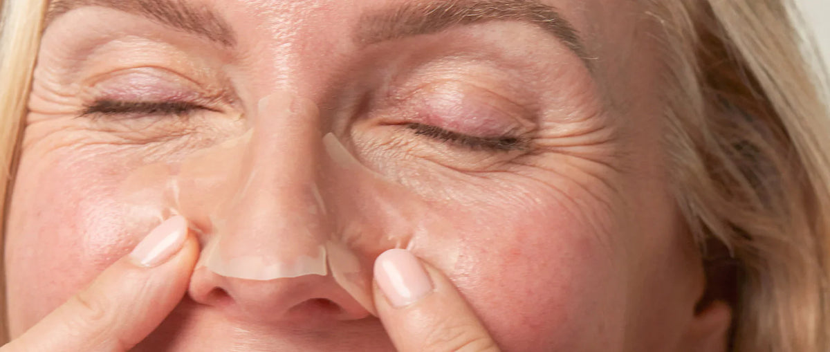 Blackheads