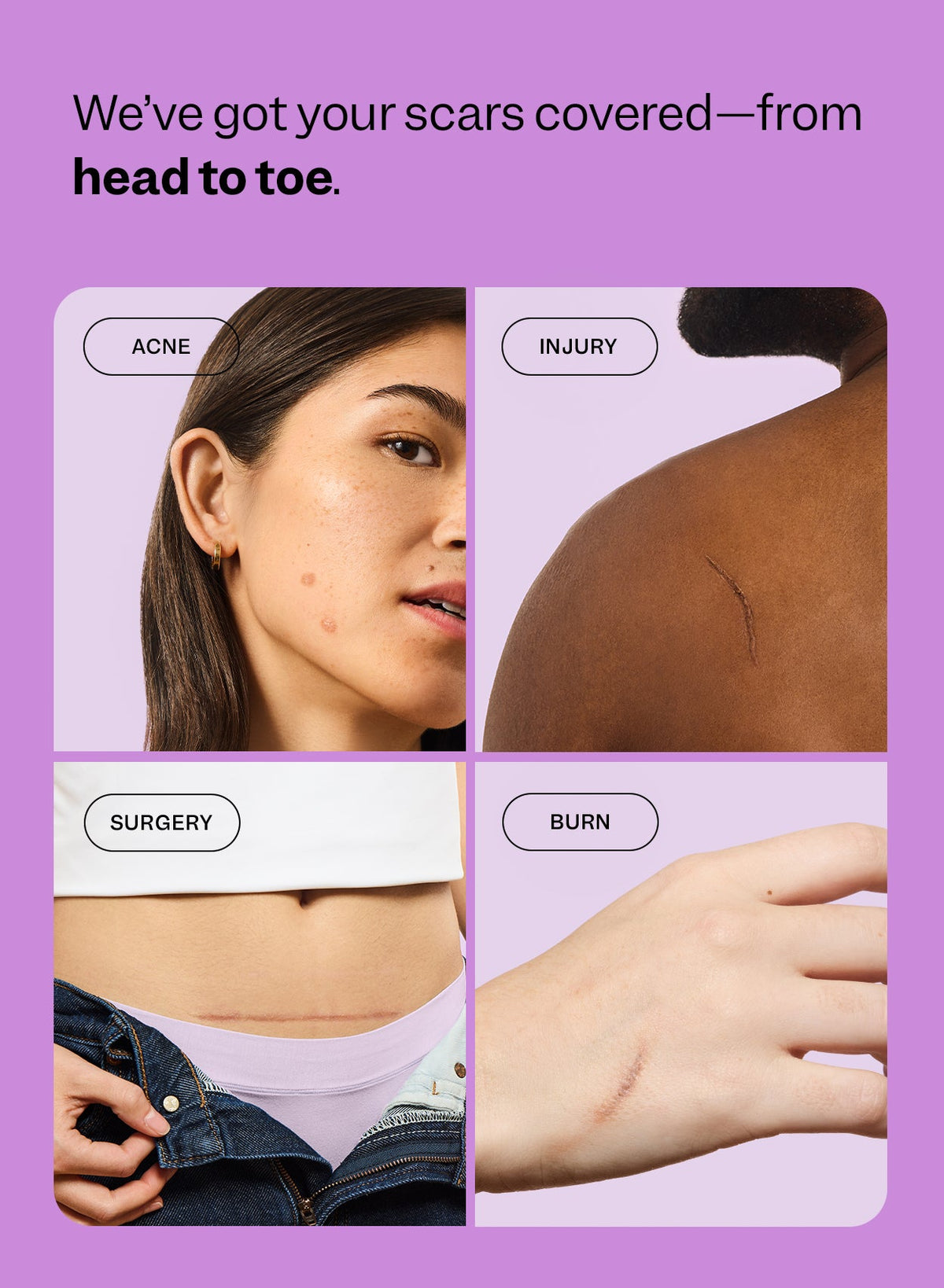 Designed to visibly improve the look of a variety of raised scar types including  acne, injury, surgery, and burns.